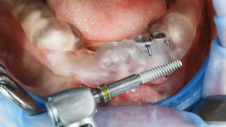 dental pattern and dental implant before the procedure