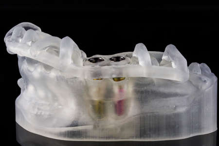 pattern on a model printed in a 3D printer with implants and abutments on a black background