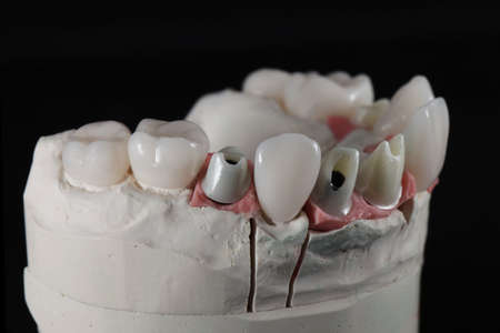 ceramic crowns and how they are installed on a special dental model