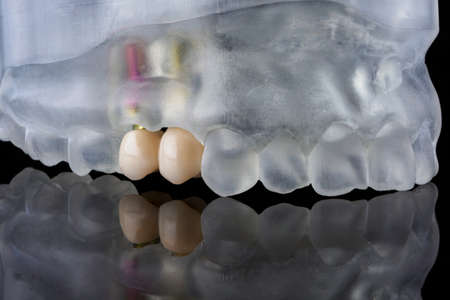 dental crowns are shown on a special model of the patient's jaw made on a 3D printer