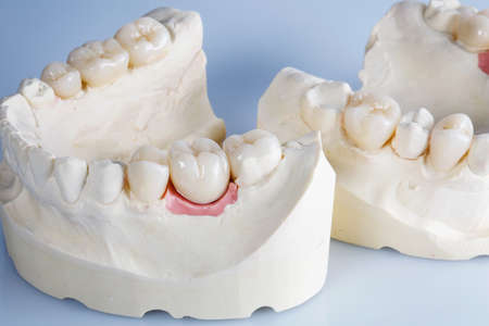 ceramic dental crowns on a model close up on a light background