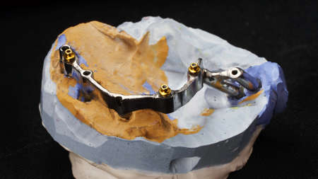 titanium beam for future dental prosthesis on the model of plaster