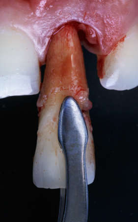 extracted front tooth before implantationの写真素材