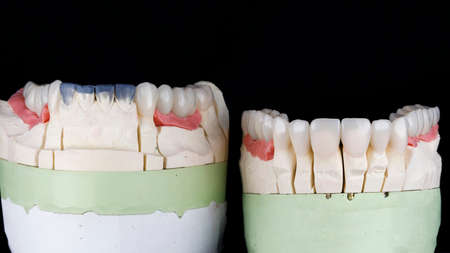 ceramic crowns and veneers on a model with a black backgroundの写真素材