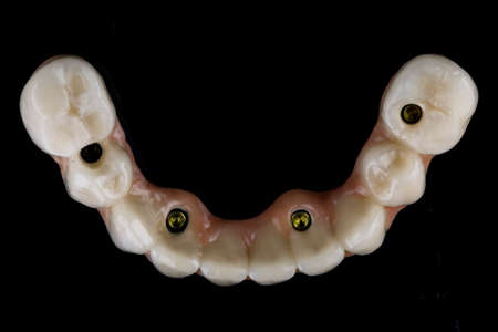dental upper jaw prosthesis with pink gum on black glass, top view