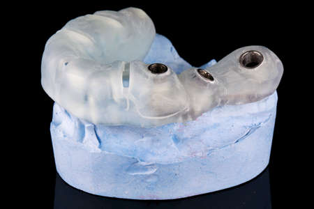 surgical dental template for three implants, shot on a plaster model with a black background