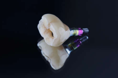 set Dental ceramic crown to set the patient photographed on a mirrorの写真素材