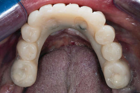 fixed denture in the oral cavity