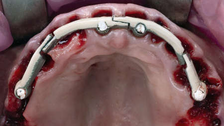 frame for welding inside the mouth for immediate loading prosthesis