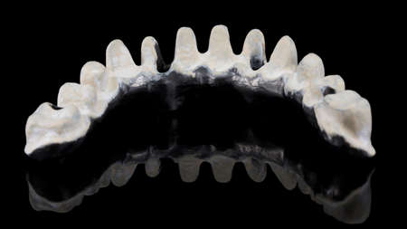dental titanium beam with Apak material on the lower jaw of the patient, removed from the inside