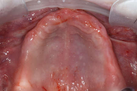 prepared under the gum implantation