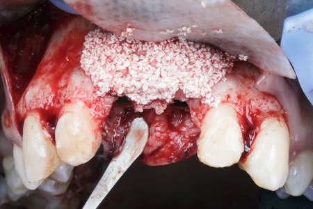 escalating the gum using artificial bone and membrane Dental