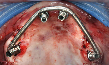 titanium abutments with titanium welding beams for prosthetics