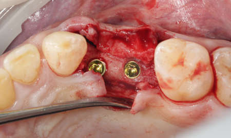 Dental implant and two sectional gumsの写真素材