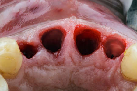 gums after removing the front incisors, for implantation