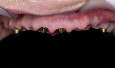 gums after two weeks after implantation at four upper jaw implantsの写真素材