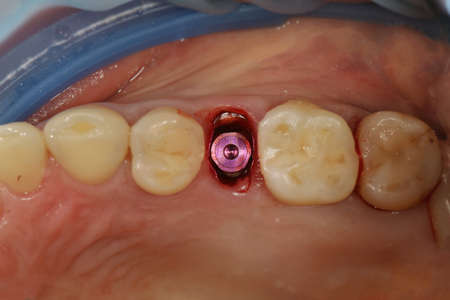 implantantat chewing teeth and his driver