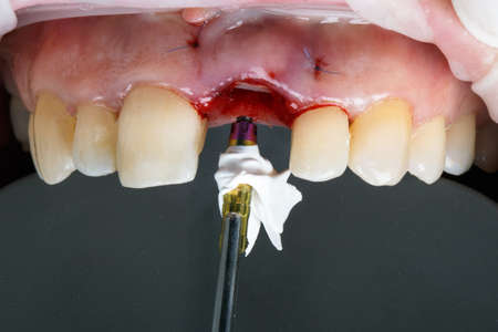 Installation Dental abutment on the cutting toolの写真素材