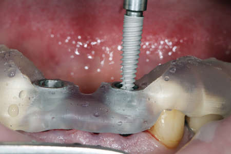 highly precise implantation of a surgical template