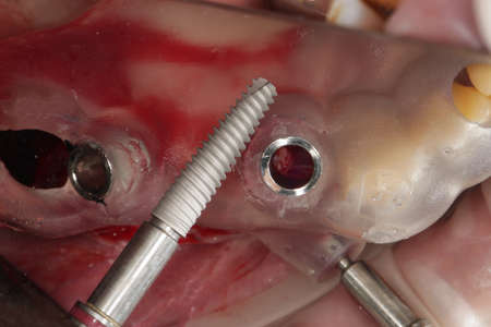 Dental implant and surgical template for precise