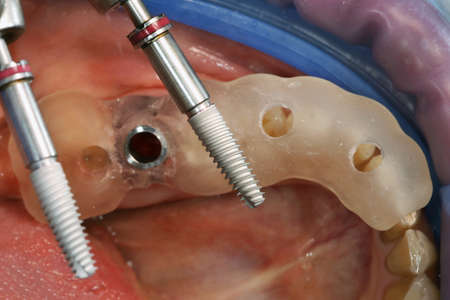 macro picture Dental implant and surgical template