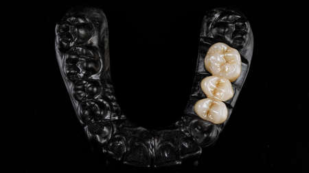 beautiful black model of the jaw and three crowns, top view on a black background
