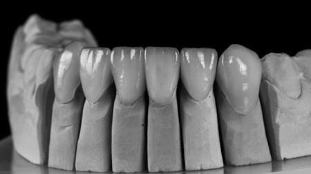 Lowned ceramic veneers on the low-jaw model in black and white photoの写真素材