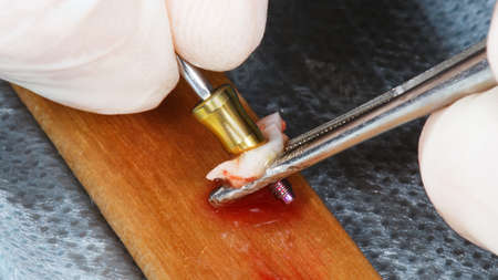 Dental Abutment with soft fabric flap for recovery during implantation