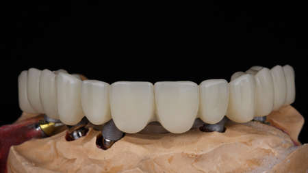 Dental prosthesis for upper jaw on model with beam, shot on black background