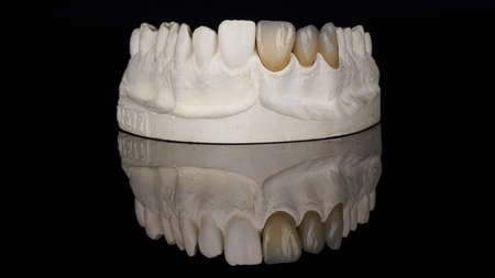 excellent composition of three porcelain veneers on the model, filmed on black glass with creative reflectionの写真素材
