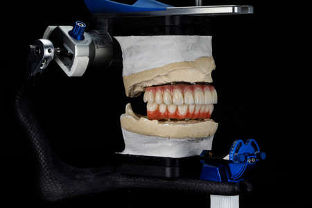 dental prostheses made of ceramics and titanium with a gum, in an articulator with a bite on a black backgroundの写真素材