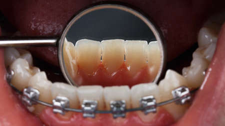 creative angle through the mirror on clean teeth after dental hygieneの写真素材
