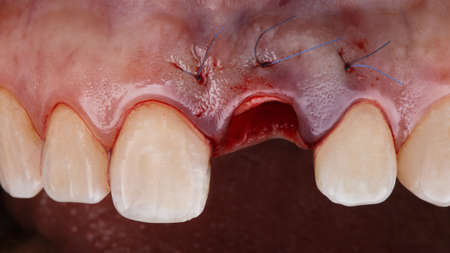 excellent macro photo of the gums after implantation and the addition of a flap to restore the...