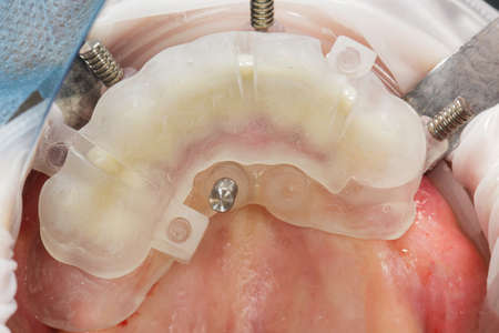 collapsible dental template in the oral cavity for implantation or reductionの写真素材