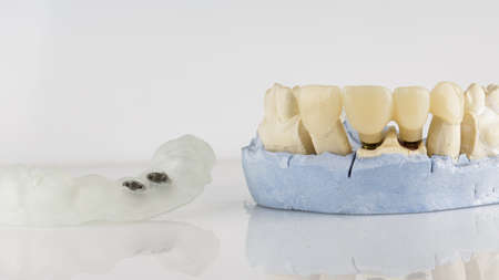 surgical template for two implants and a model with crowns on a white background