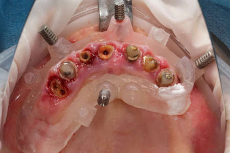 surgical template in the oral cavity before tooth extraction and subsequent implantation