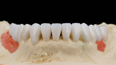ceramic veneers on a lower jaw model on a black background