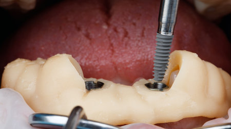 dental moment before installing an implant in the lower jaw through a templateの写真素材