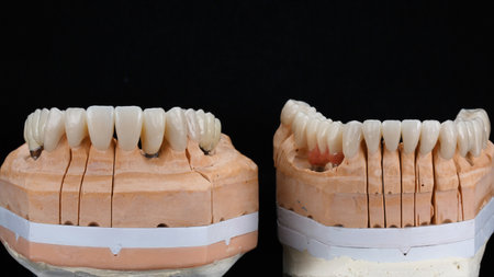 two dental models with crowns and bridges for both jawsの写真素材