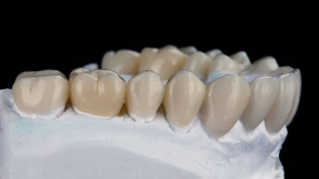 a set of ceramic crowns with masticatory anatomy on a plaster model, photo on a black backgroundの写真素材
