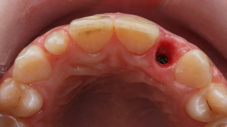 view through the mirror on the jaw with the installed dental implant for the installation of the crownの写真素材