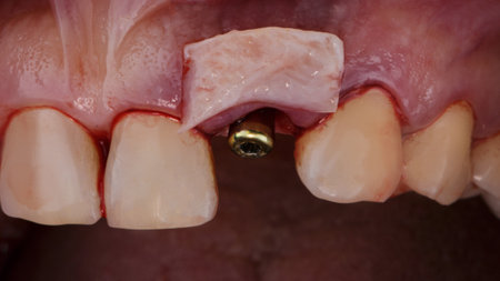 soft tissue flap on the gum for tissue grafting