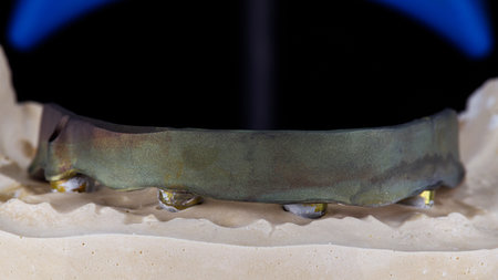 dental beam made of metal for a future prosthesis on a model