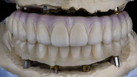 prostheses of the upper and lower jaws with painted pink artificial gums in the bite on models