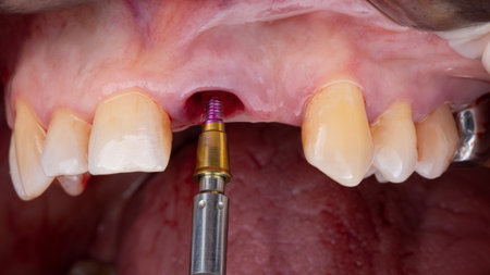 installation of a dental abutment after implantation of the central toothの写真素材