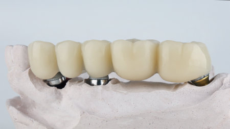 dental bridge prosthesis of five chewing teeth on a beam with a model