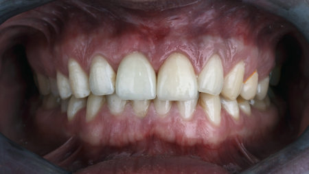 installed ceramic dental crown of the central tooth of natural color and shapeの写真素材