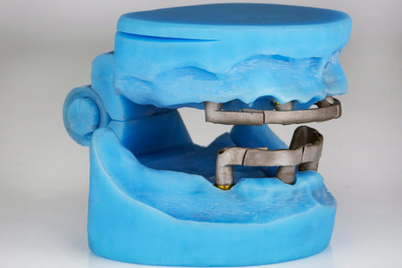 blue dental model of the jaws with two cobalt-chromium beams for future prosthetics, side view on a...