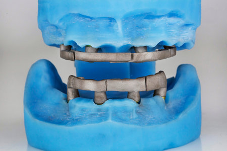 blue dental model of the jaws with two cobalt-chromium beams for future prostheticsの写真素材