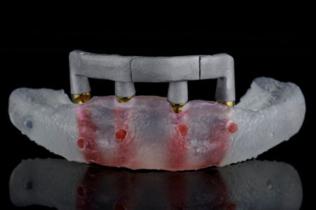 metal dental bar on the model of the lower jaw on a black background